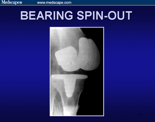 RotatingPlatform Total Knee Arthroplasty