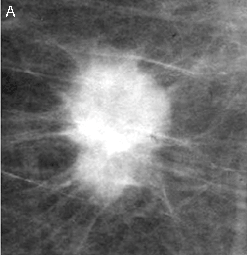 Breast Cancer Biopsy Methods
