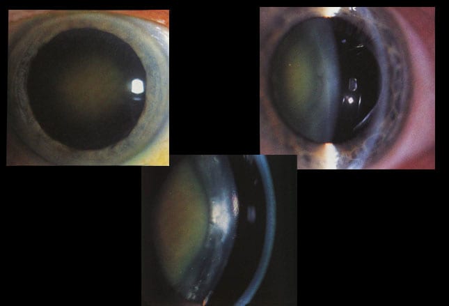 What the Eyes Tell You 17 Abnormalities of the Lens