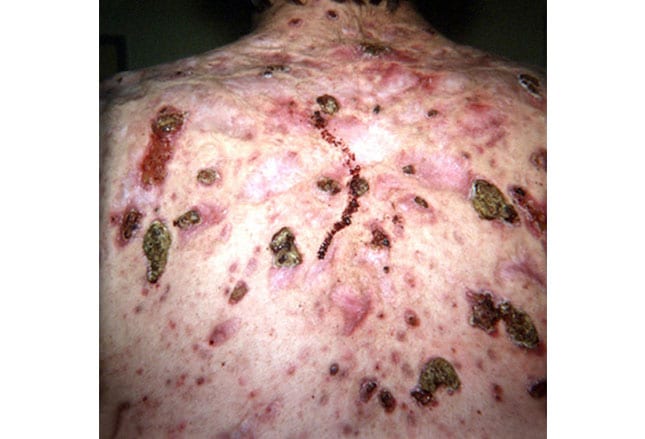 Acne Picture Image on MedicineNet.com