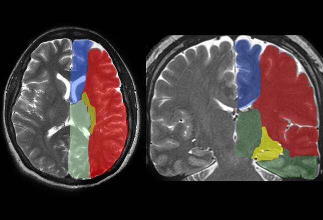 acute ischemic vertebrobasilar artery cerebellar stroke icd 10