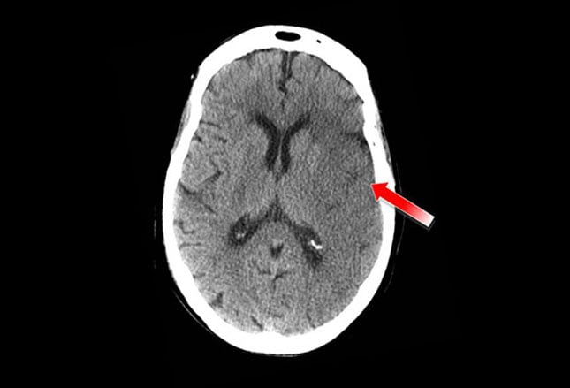 acute-stroke-critical-findings-you-can-t-miss