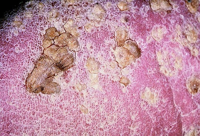 kidney cancer signs and remedy