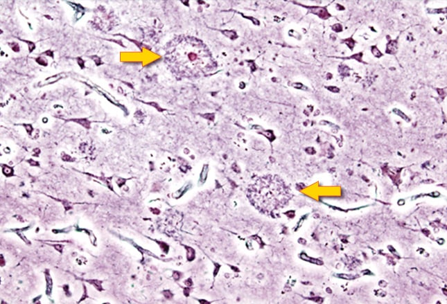 alzheimers disease essay conclusion Essays related to causes and effects of alzheimer's disease in this essay i will discuss alzheimer's disease although alzheimers is a terrible disease and. alzheimers disease essay conclusion Essays related to causes and effects of alzheimer's disease in this essay i will discuss alzheimer's disease although alzheimers is a terrible disease and.