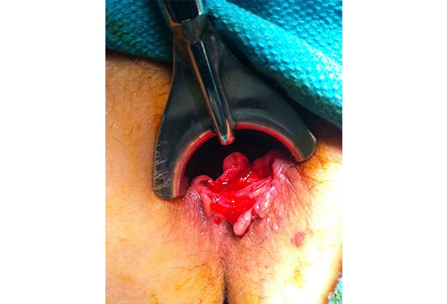 diagnosis of anal cancer free mature heels boobs