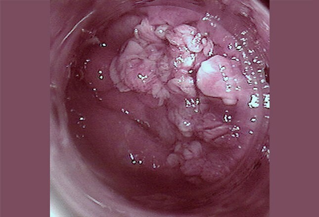 the hottest naked pics south africa diagnosis of anal cancer