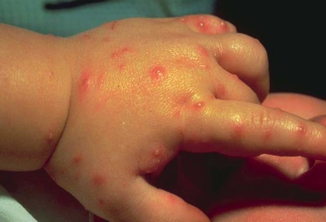 bug bite on infant #10