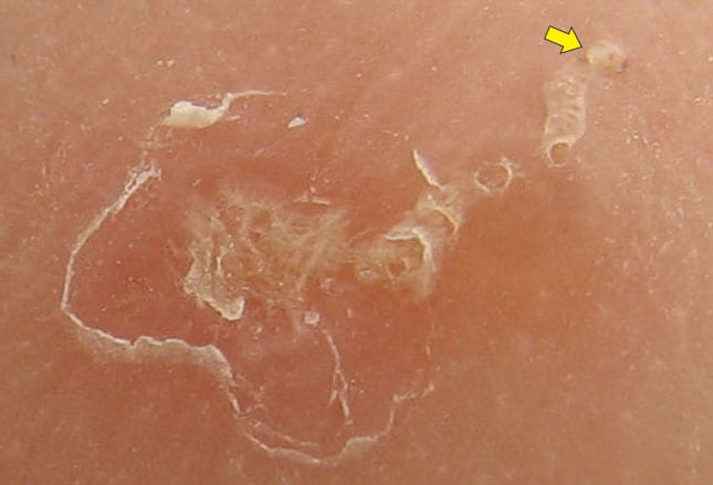What kills human demodex mites?