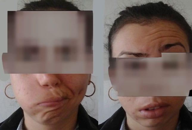 What are the symptoms of Bell's palsy?