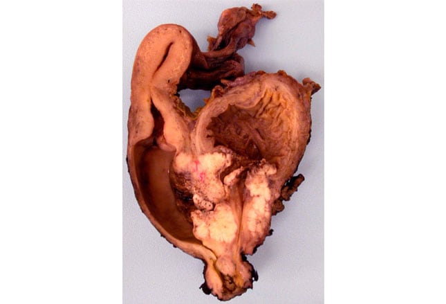 smoking and urinary bladder carcinoma Studies of urothelial bladder cancer have identified multiple risk factors, the most important of which are cigarette smoking and various. smoking and urinary bladder carcinoma Studies of urothelial bladder cancer have identified multiple risk factors, the most important of which are cigarette smoking and various.