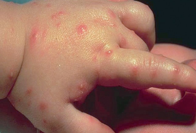 Flea Bites on Humans: Symptoms and Treatment | Dengarden