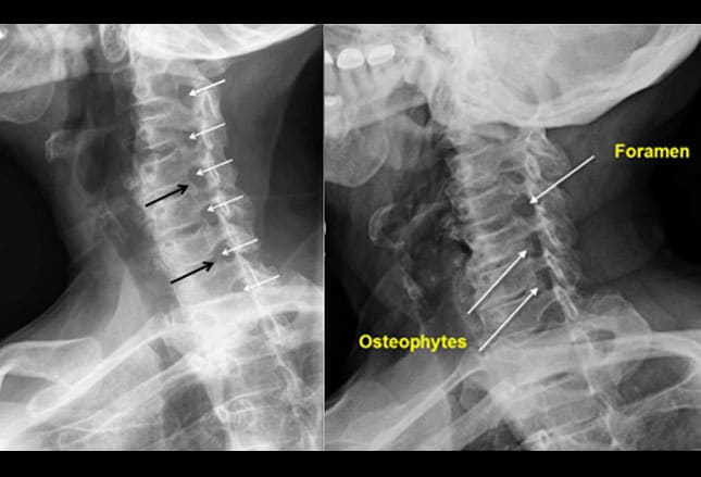 x ray database cervical spine
