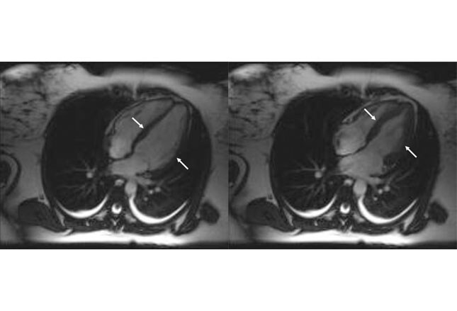 Keys To Diagnosing Broken Heart Syndrome (Takotsubo Cardiomyopathy)