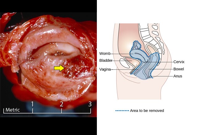 cervical most cancers overlooked duration cervical most cancers symptoms my tale