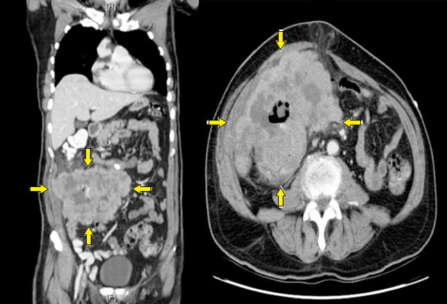 colorectal-cancer-prevention-diagnosis-and-therapeutic-options