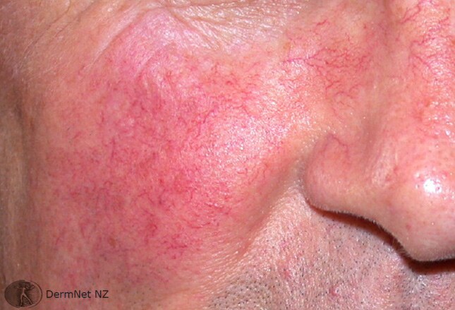 oral manifestations caused by drug abuse This article is intended as a general overview of conditions with oral manifestations of systemic absence of other known causes such as drugs drugs of abuse. oral manifestations caused by drug abuse This article is intended as a general overview of conditions with oral manifestations of systemic absence of other known causes such as drugs drugs of abuse.