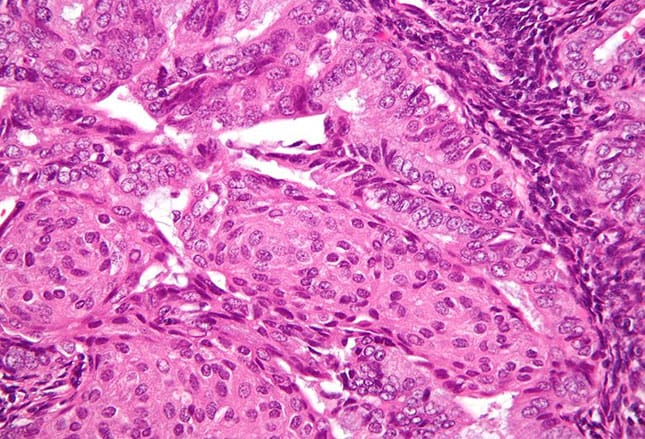 Endometrial most cancers Curable