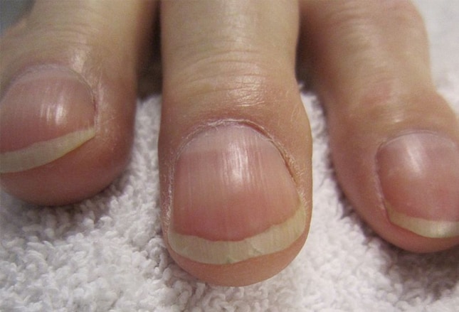 fingernail-and-toenail-abnormalities-nail-the-diagnosis