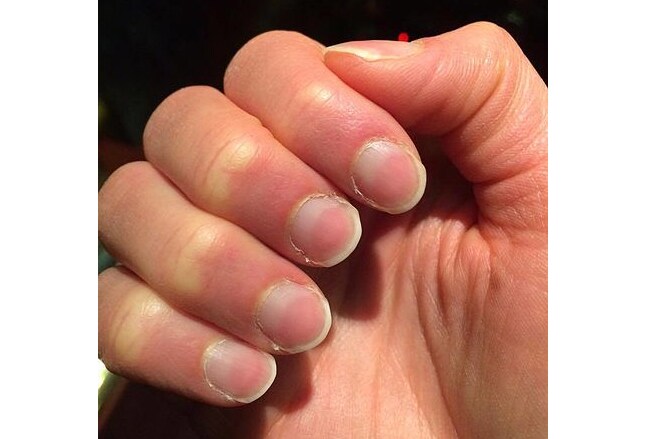 misshapen finger nails