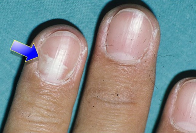 White Spot Nail Bed White Spot Nail Bed