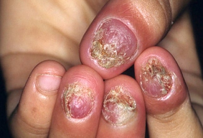 toenail fungus or psoriasis
