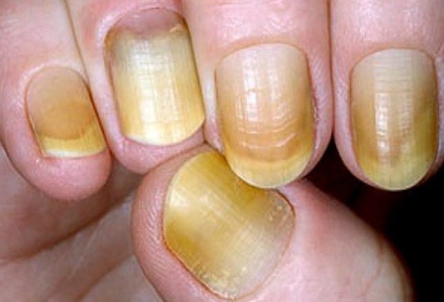 Fingernail And Toenail Abnormalities Nail The Diagnosis