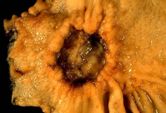 stomach cancer epidemiology
