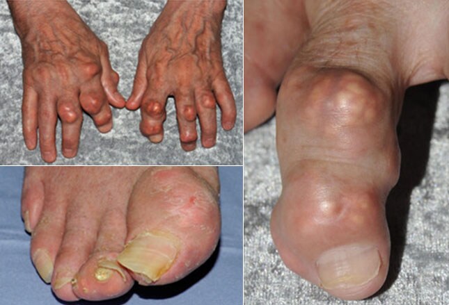 Colchicine Gout Flare