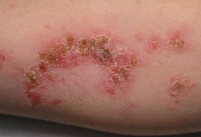 Bacterial Skin Infections Can You Make the Diagnosis?