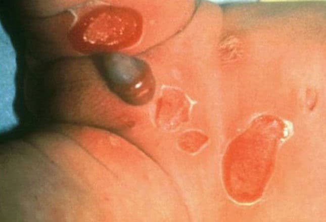 Skin Fungal Infections: Symptoms, Causes, Treatments