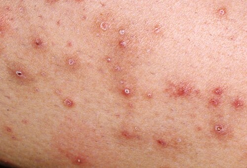 Bacterial skin infections and school