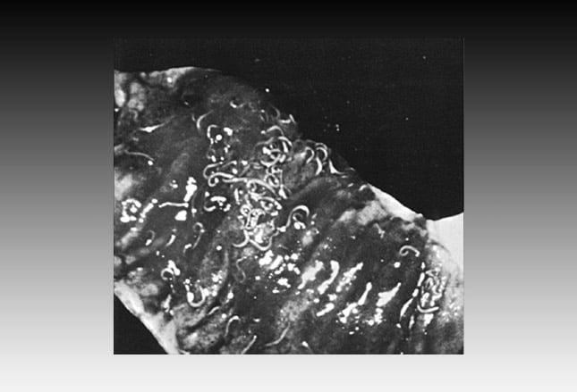 Common Intestinal Parasites: Slideshow