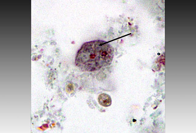 Common Intestinal Parasites: Slideshow