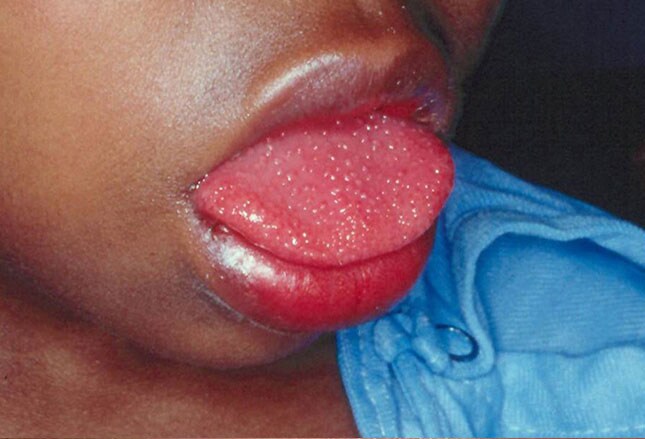 Kawasaki Disease Medscape Treatment Kawasaki Disease Medscape Treatment