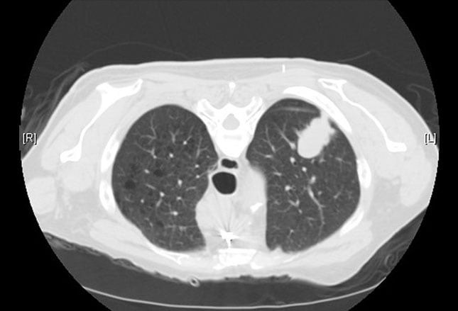 Lung Cancer Staging: Imaging Options