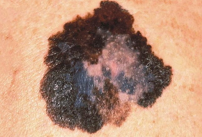 Is there a website with pictures that show the difference between melanomas and moles?