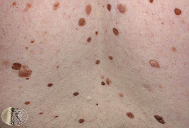 Is there a website with pictures that show the difference between melanomas and moles?