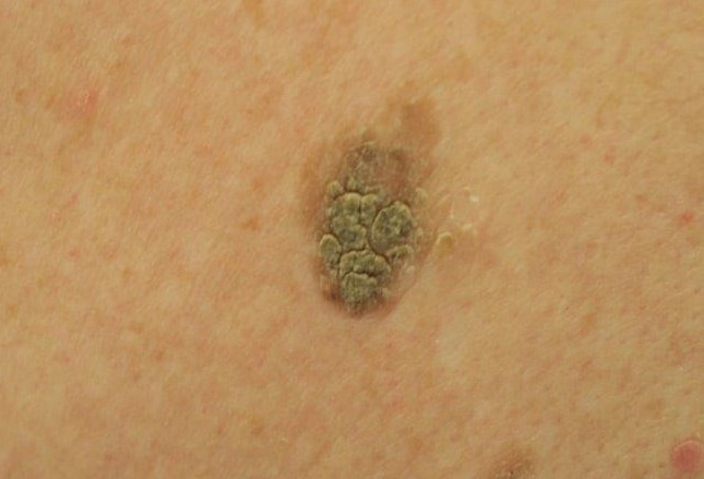 gray spots on skin | Lifescript.com