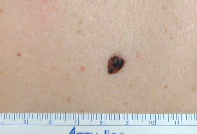 How do you identify melanoma?