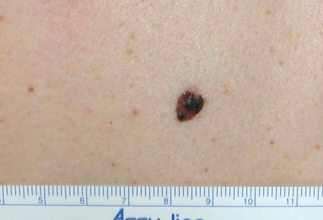 Melanoma in situ - what questions should I ask | Melanoma ...