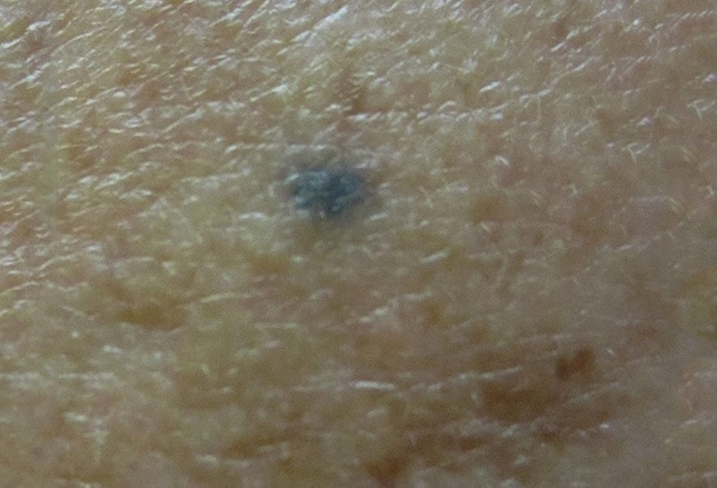 mole-or-melanoma-test-yourself-with-these-suspicious-lesions