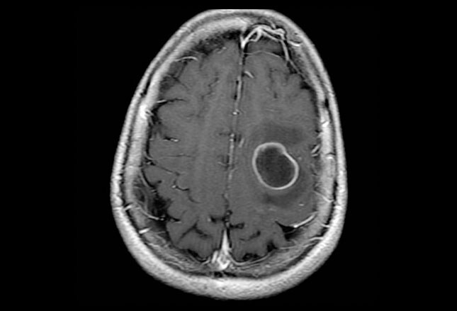 Does Propecia Cause Cancer