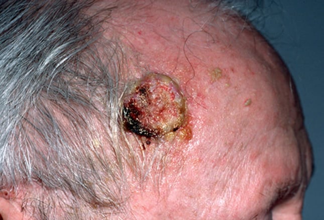 Pictures of Skin Malignancies and Problems - Skin Cancer