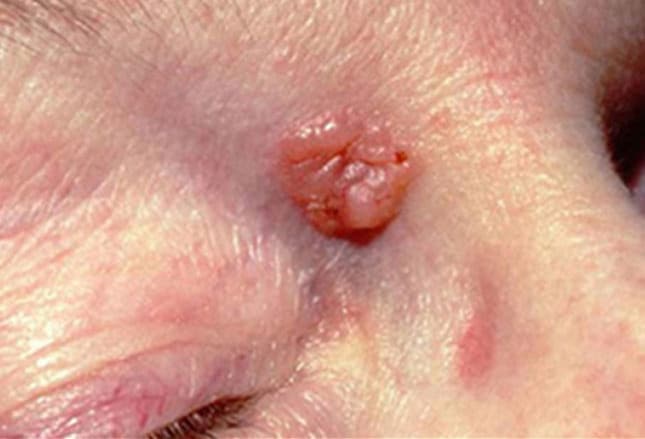 Basal Cell Carcinoma Treatment Options - SkinCancer.org
