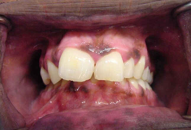 severe calculus buildup in mouth severe calculus buildup in mouth