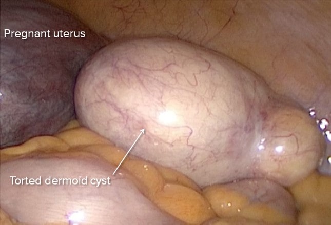 Is pregnancy possible with an ovarian cyst?