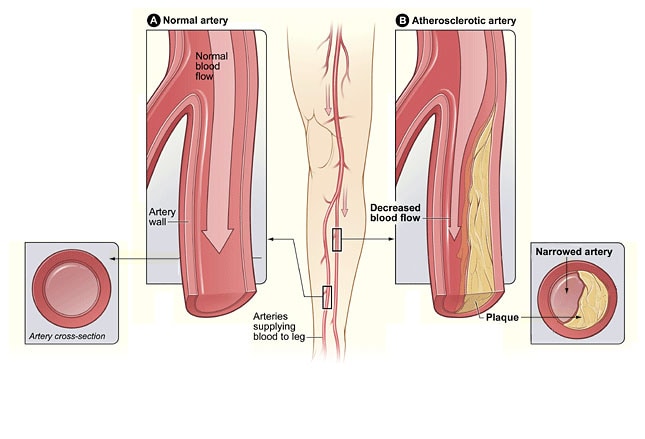 peripheral-arterial-disease