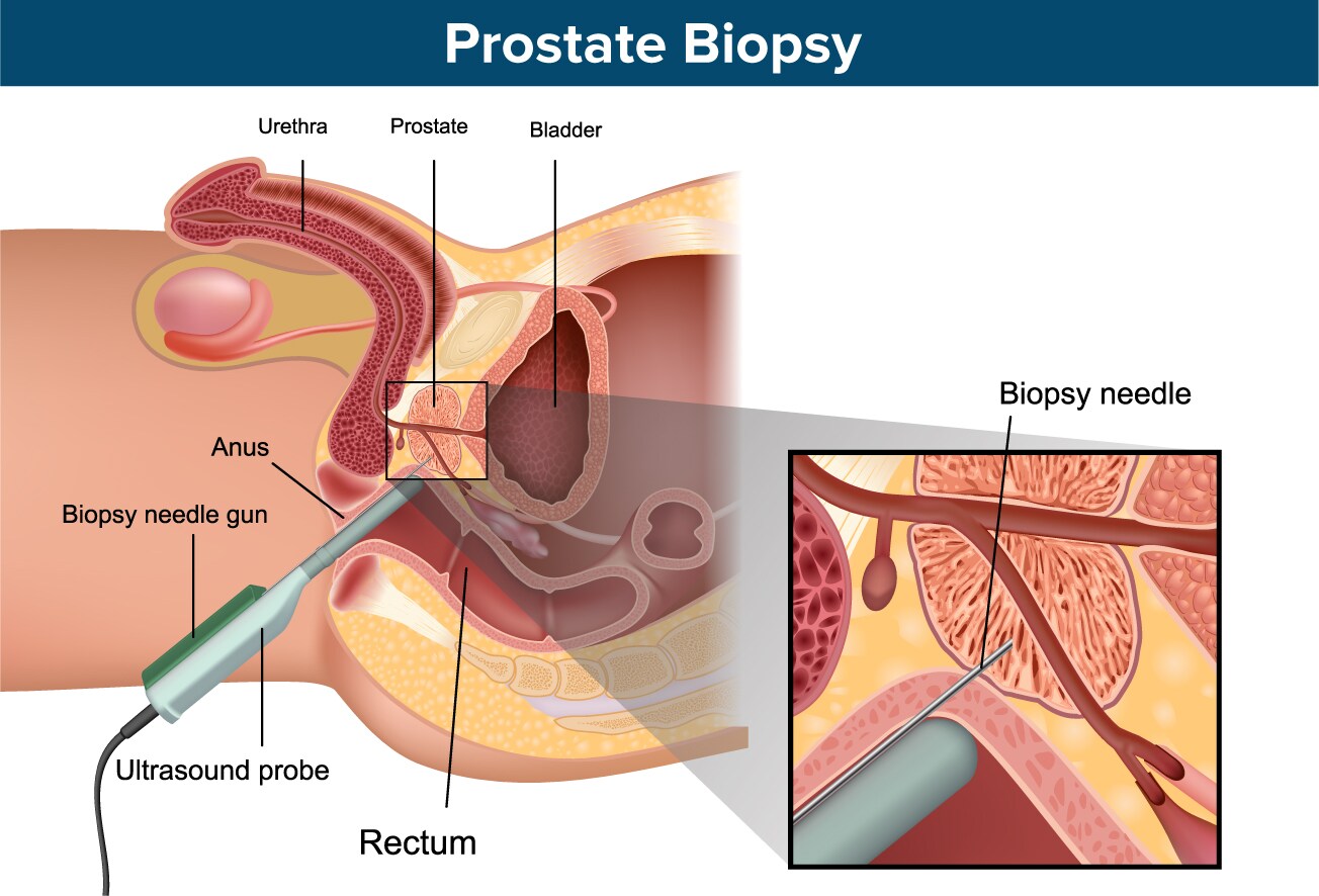 prostatitis: an inflammatory story