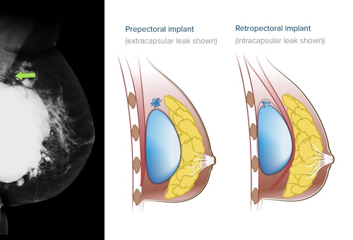 Breast cancer swelling and rupture