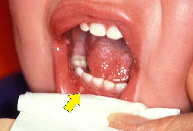 Terbinafine Topical Medscape